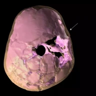 بازسازی سه‌بعدی، ضربه مغزی نوجوان قذفه ۱۱