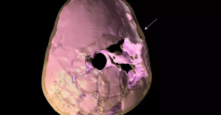 بازسازی سه‌بعدی، ضربه مغزی نوجوان قذفه ۱۱