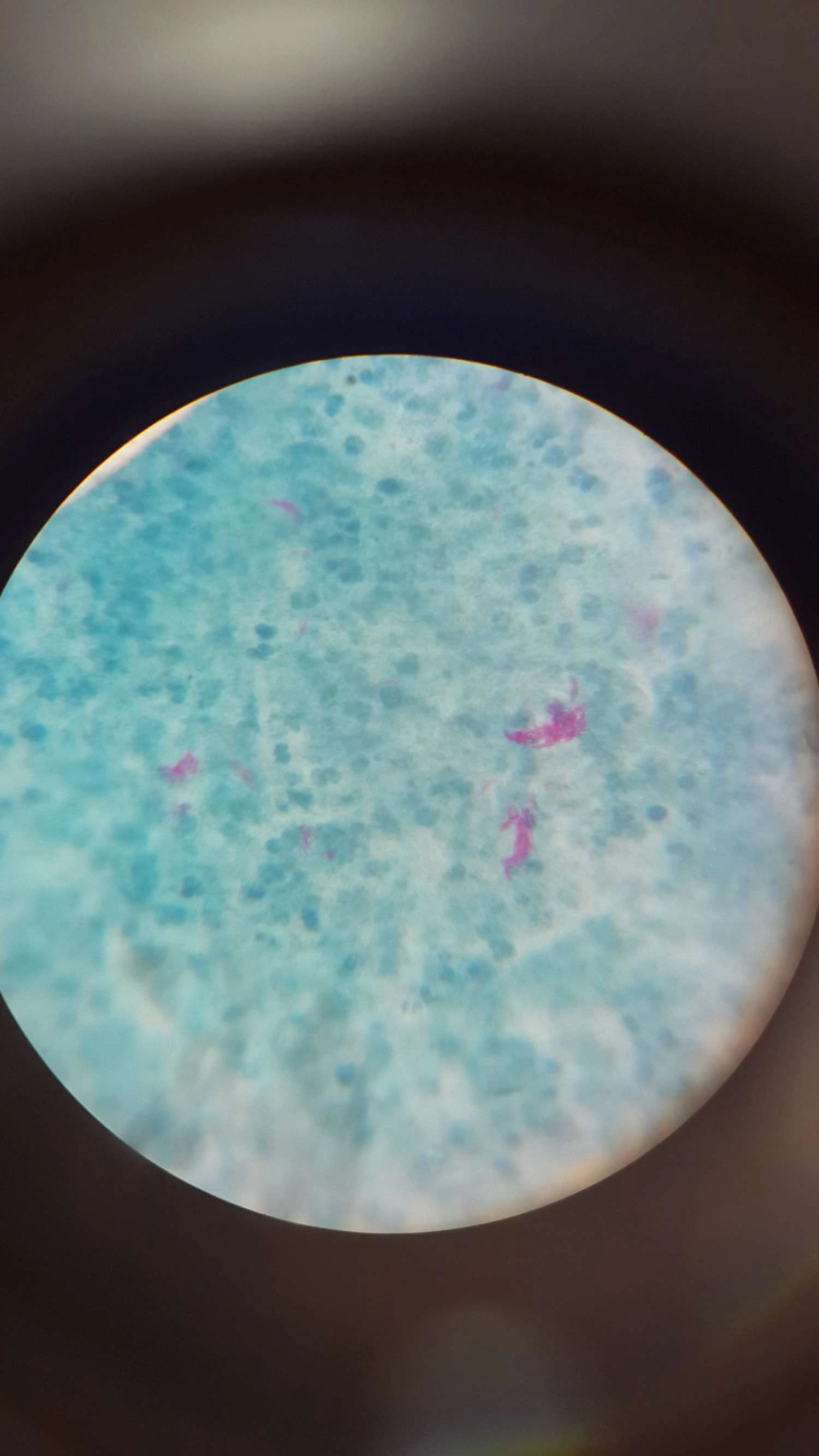 تصویر میکروسکوپی از باکتری عامل جذام